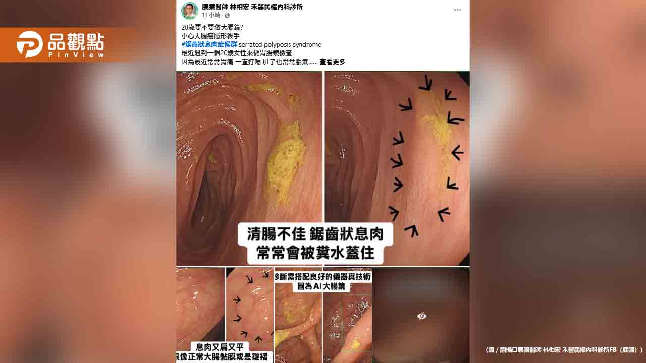 20歲女做大腸鏡！醫生嚇到：超過20顆以上「鋸齒狀息肉」