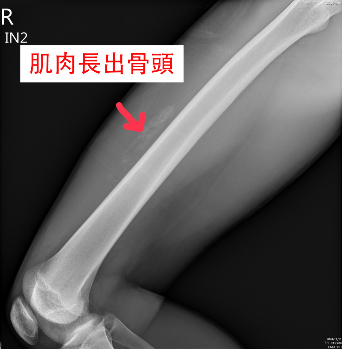 醫師發現青少年股四頭肌長出「骨頭」,即骨化性肌炎,屬肌肉損傷引起的鈣化性病變,常見於15至30歲的年輕人。(圖/記者林照東翻攝)
