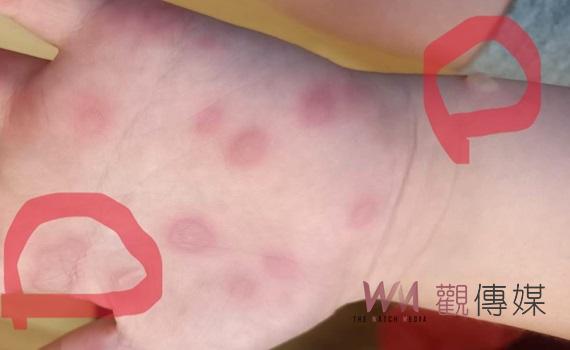 腸病毒疫情高峰來襲! 雲林長庚籲家長警惕守護孩子健康
