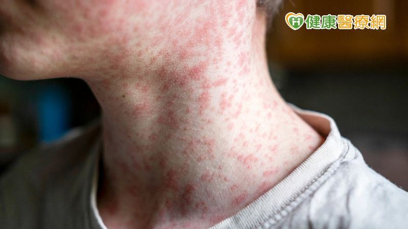醫院麻疹群聚再增7例!匡列千名接觸者 有效預防方式曝