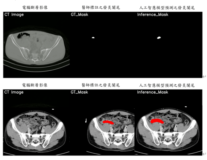 AI助力醫療突破診斷困境!元智攜手亞東榮獲國家新創獎肯定 63 圖三元智電機系攜手亞東影像醫學科團隊,使用電腦斷層掃描影像,進行判別是否發生急