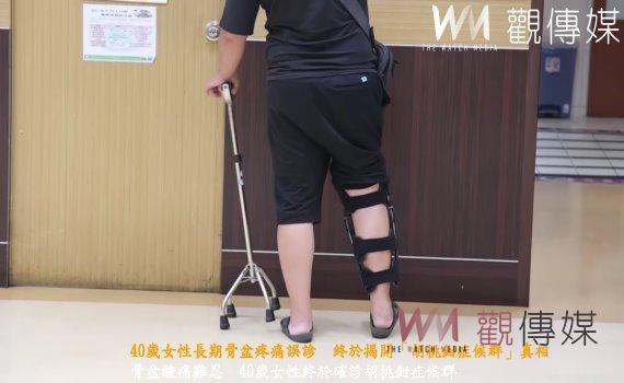 (有影片)/40歲女性長期骨盆疼痛誤診 終於揭開「胡桃鉗症候群」真相