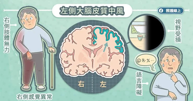 左側大腦皮質中風:影響語言與視覺