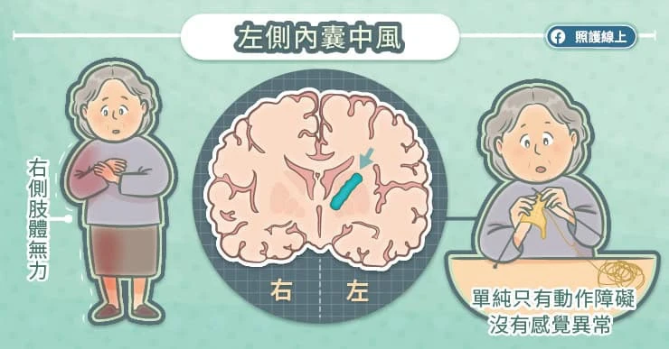 左側內囊中風:只有動作障礙