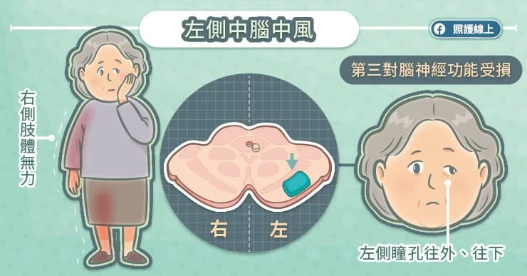 左側中腦中風:影響左眼神經