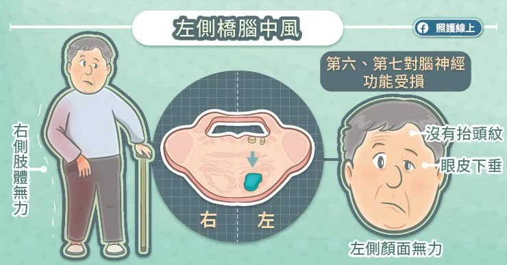 左側橋腦中風:無法挑動眉毛