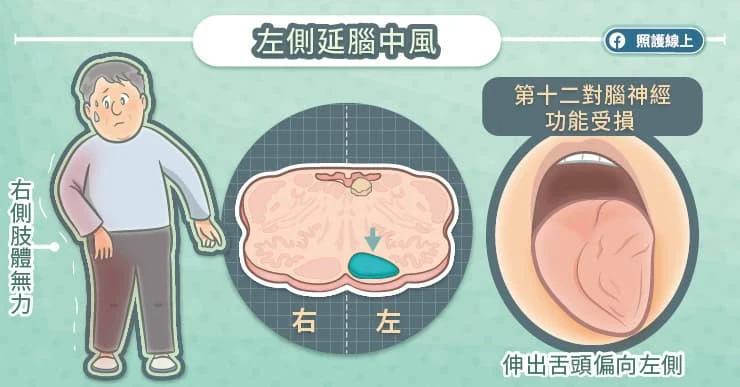 左側延腦中風:舌頭偏向左側