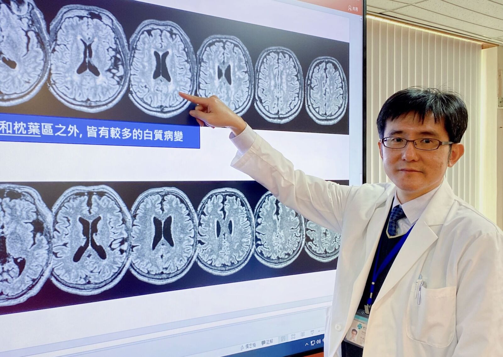 台灣人特有1%基因變異作怪 中榮研究:48歲後就可能腦中風、失智! 242 台灣人特有1%基因變異作怪 中榮研究:48歲後就可能腦中風、失智! 241