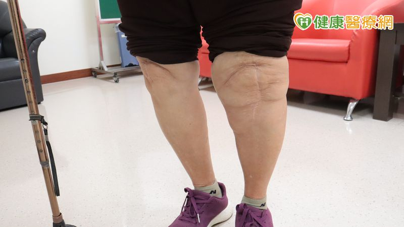 置換人工關節併發慢性骨髓炎 高壓氧治療助重拾行動力