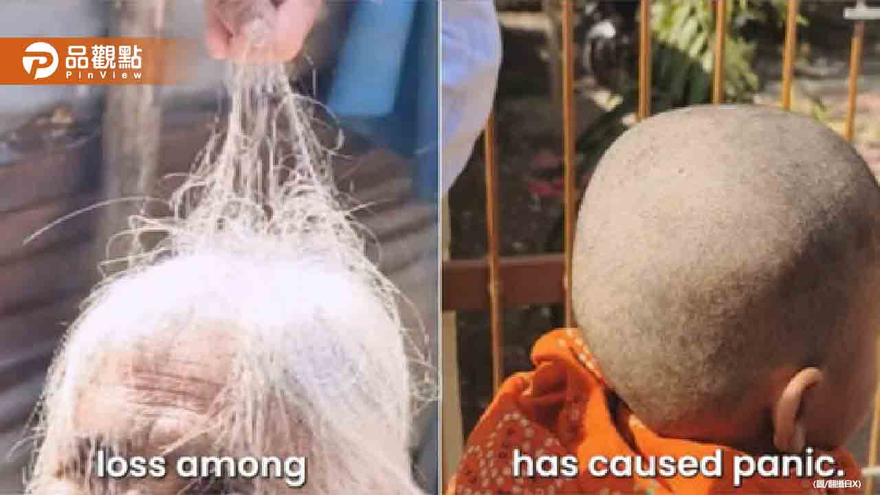 印度村莊怪病肆虐!30多人「集體掉髮」變禿頭