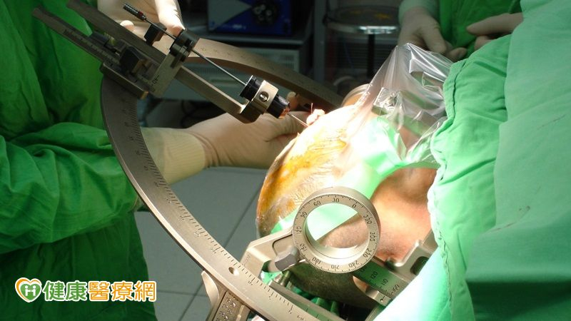 AI導引加持! 北榮影像程控深層腦部刺激術 助動作障礙患者重啟人生