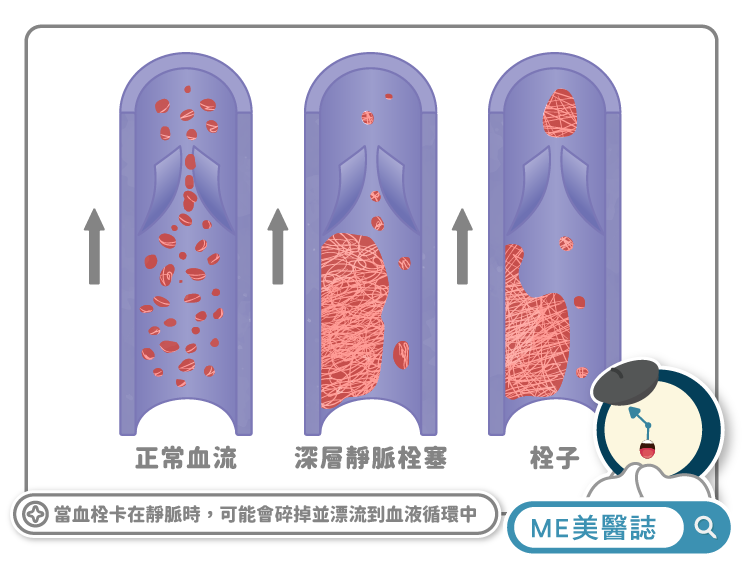 深層靜脈血栓