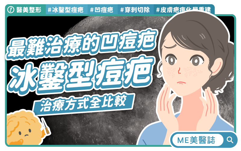 冰鑿型痘疤治療方式比較！雷射、電波哪種好？你聽過穿刺切除嗎？–美醫懶人包｜ME美醫誌