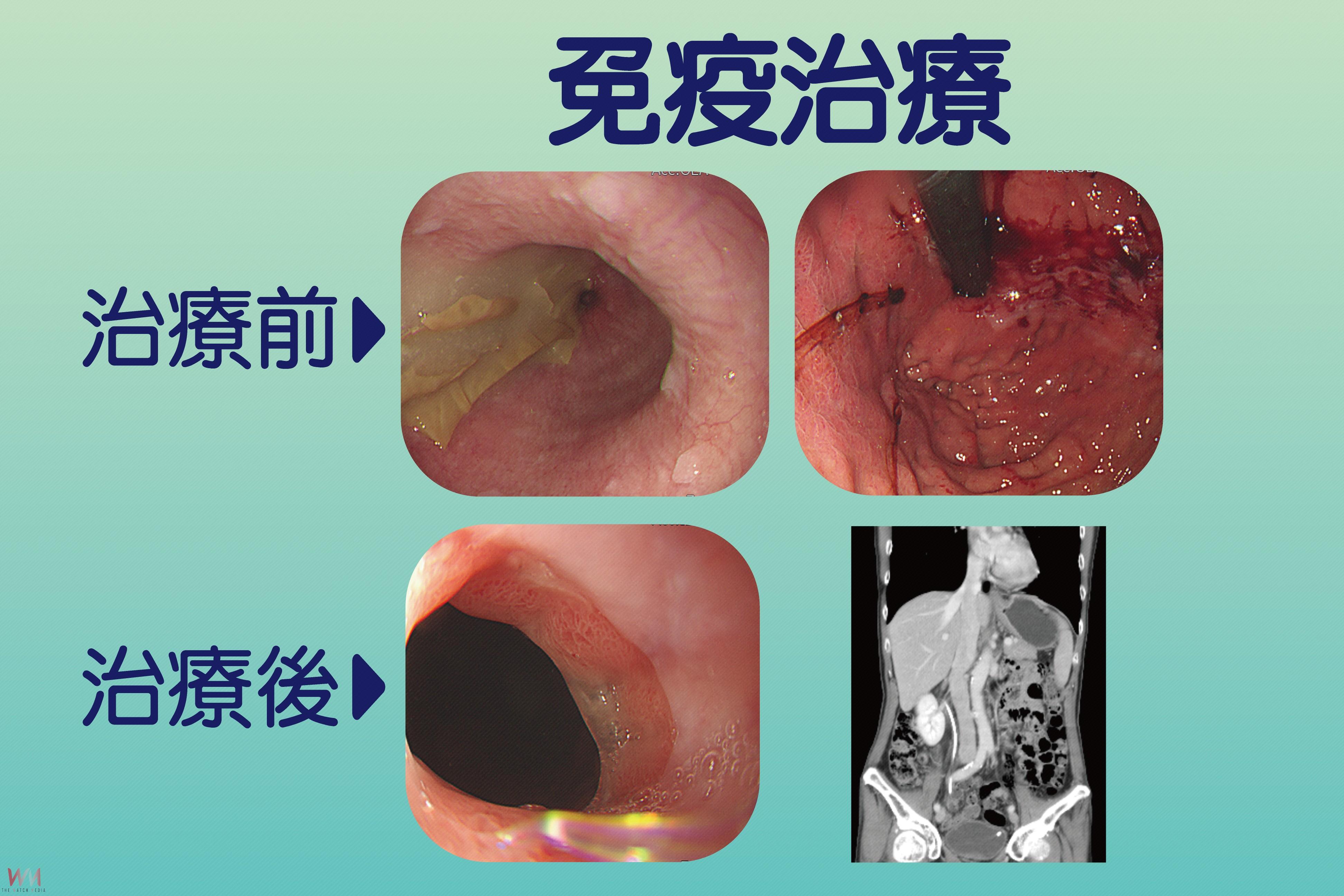 翻轉棘手胃癌 台中慈濟醫院成績緊追日韓數據亮眼 - https://www.watchmedia01.com