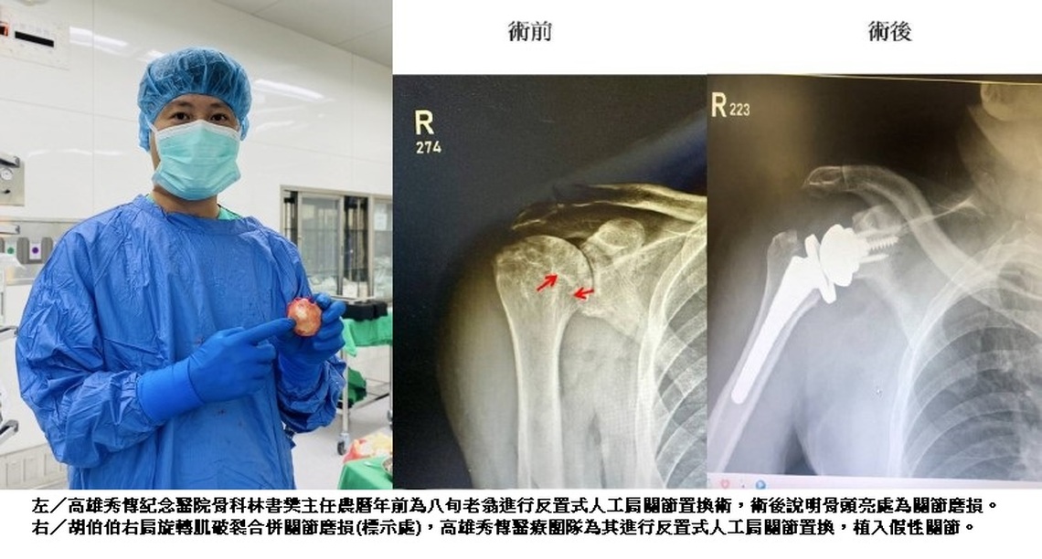反置肩關節換術創奇蹟 八旬翁重燃網球冠軍夢