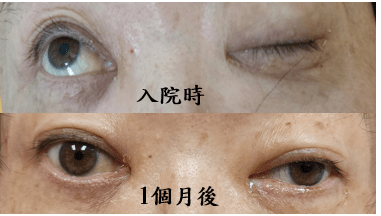 不是中風!眼睛張不開 北榮桃園分院診斷是這疾病導致 53 fwg5tf