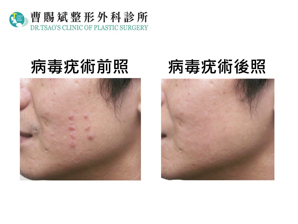 蛇年迎新 臉頰黑痣呈髒亂 高頻電波療法還新臉