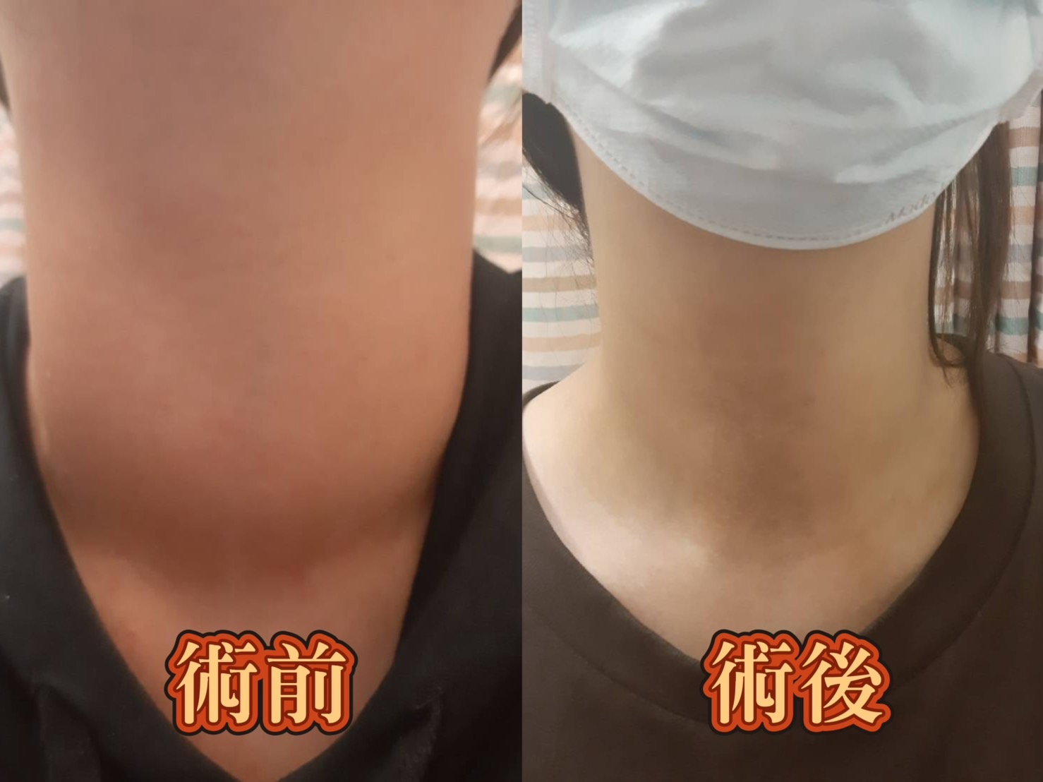 （有影片）／年輕女子飽受甲亢困擾　微創手術助擺脫「大脖子」重拾自信