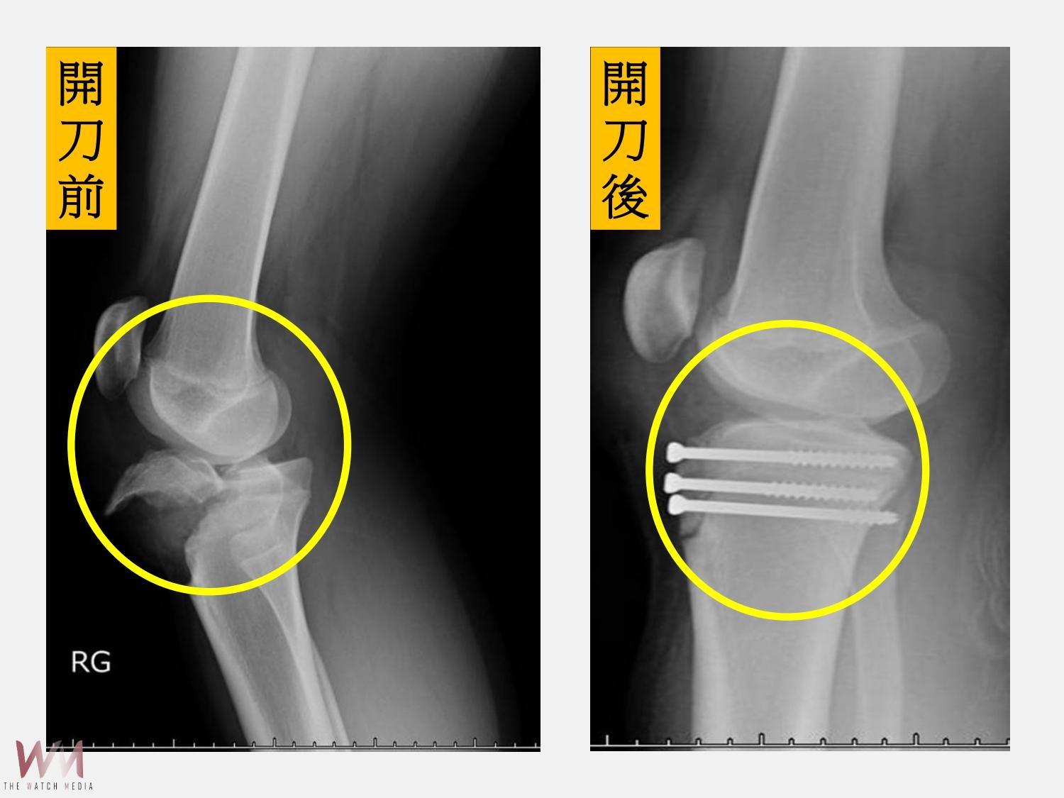 右膝近端脛骨骨折合併生長板受損 仁愛長庚:復位固定手術助復原 - https://www.watchmedia01.com