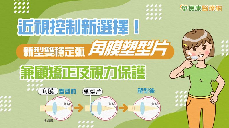 近視控制新選擇!新型雙穩定弧角膜塑型片兼顧矯正及視力保護