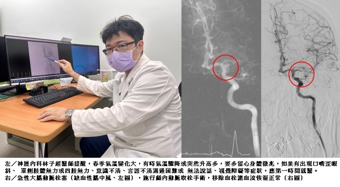 強化急重症醫療 小港醫院取栓團隊黃金時間搶救腦中風
