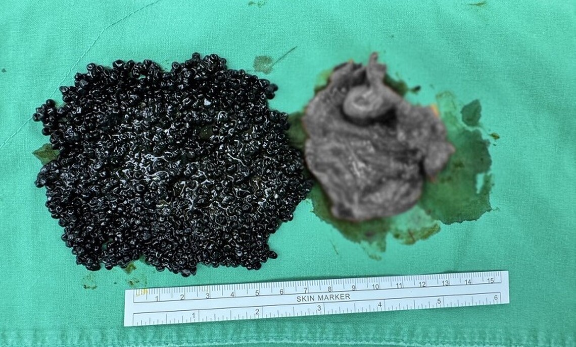 輕熟女大啖火鍋後喊腹痛  醫驚見「魚子醬」狀結石塞爆膽囊