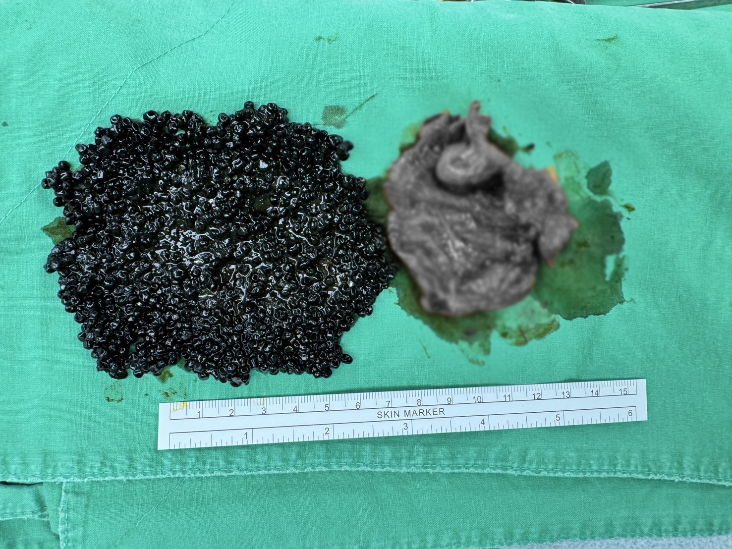 輕熟女大啖火鍋後喊腹痛 醫手術驚見「魚子醬」狀結石塞爆膽囊