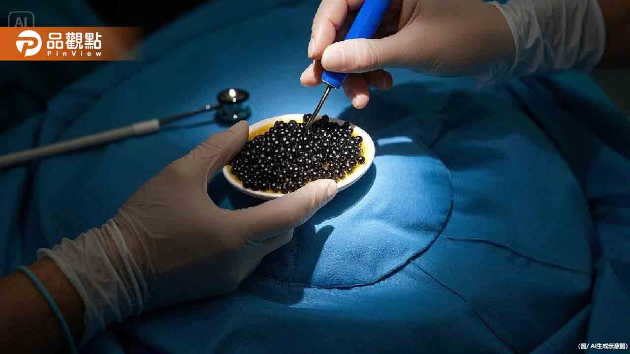 驚!女子火鍋後腹痛 醫切開膽囊驚見滿滿「魚子醬」