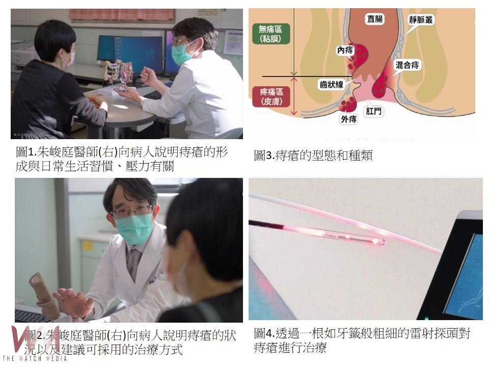 嘉基以先進「雷射消融術」 讓「痔」者重生擺脫困擾 - https://www.watchmedia01.com