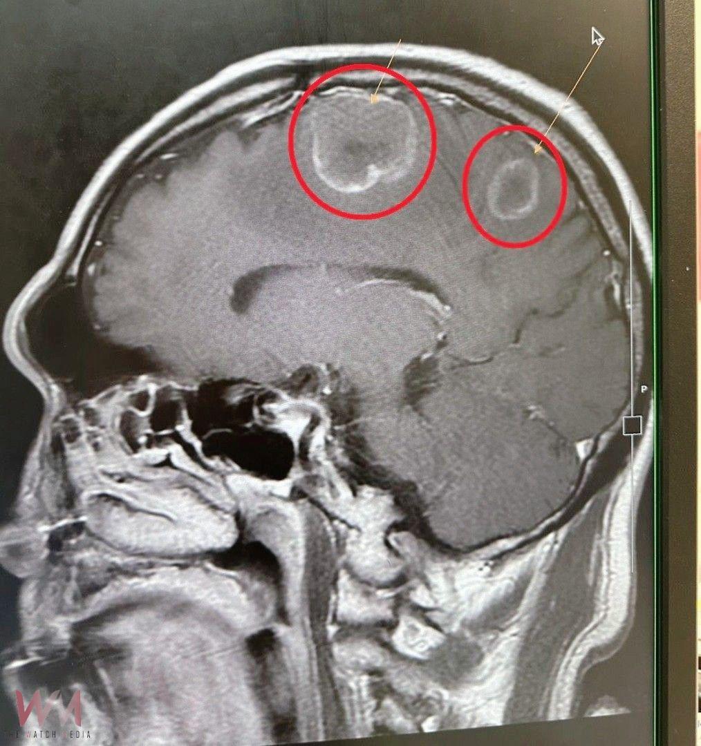 6旬翁腳無力竟是肺癌腦轉移　醫籲：出現這些症狀速就醫 - https://www.watchmedia01.com
