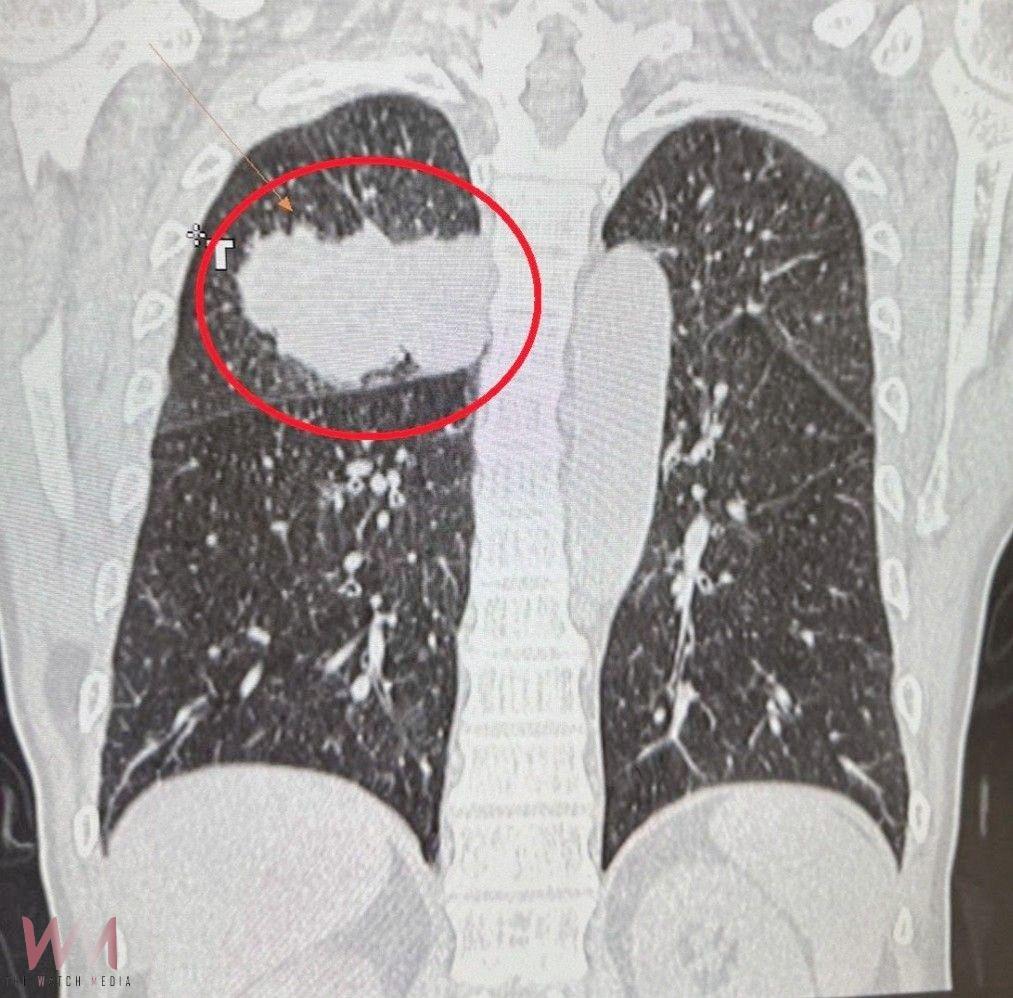 6旬翁腳無力竟是肺癌腦轉移　醫籲：出現這些症狀速就醫 - https://www.watchmedia01.com
