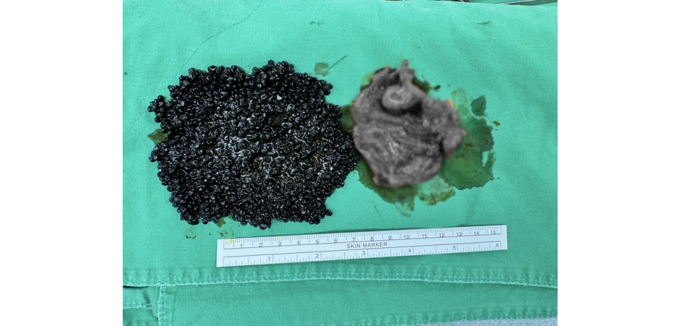 輕熟女大啖火鍋後喊腹痛 醫驚見「魚子醬」狀結石塞爆膽囊