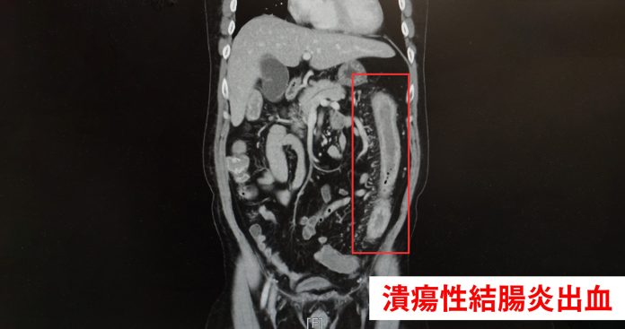 他患潰瘍性結腸炎險喪命 中醫大新竹附醫曝只因做了這事 65 結腸炎出血 scaled