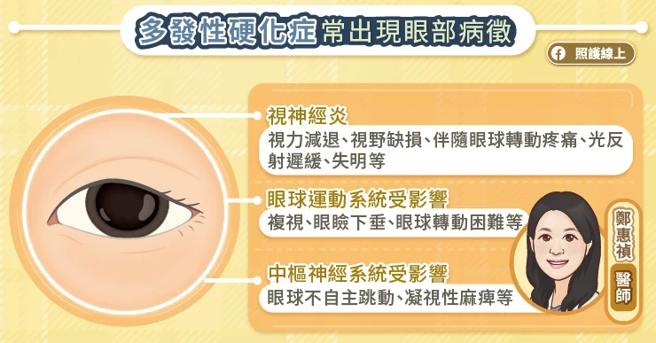 多發性硬化症常有眼部症狀