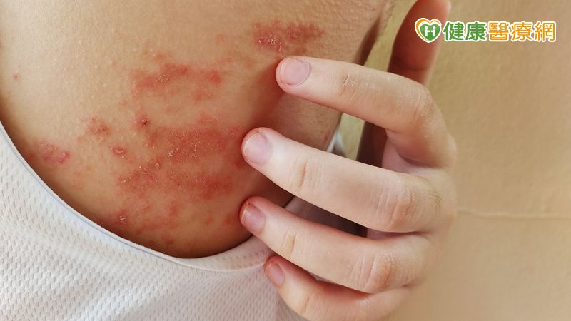 異位性皮膚炎患者有救了!最新治療法曝光 助遠離反覆發作
