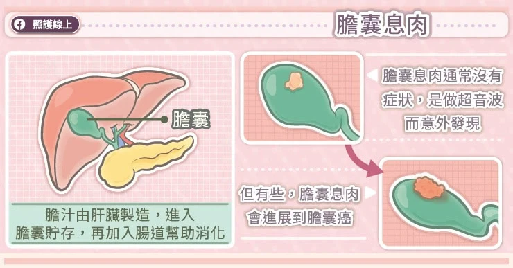 膽囊息肉是什麼？