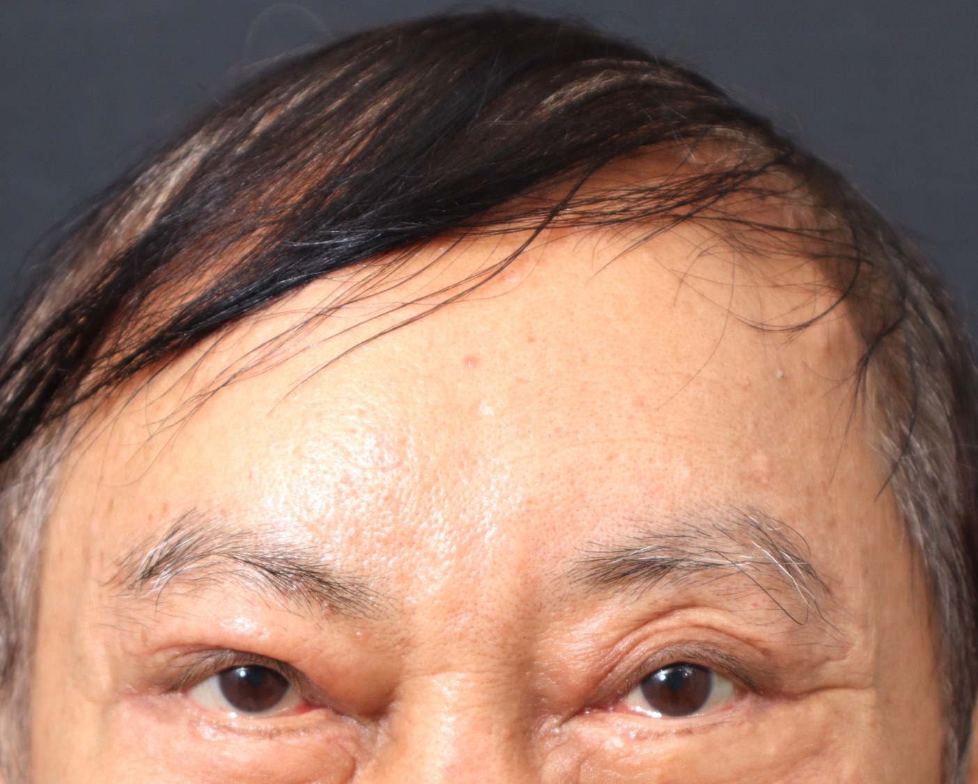 老醫師整形為追夢 額頭拉皮還我年輕本色 再創事業第二春