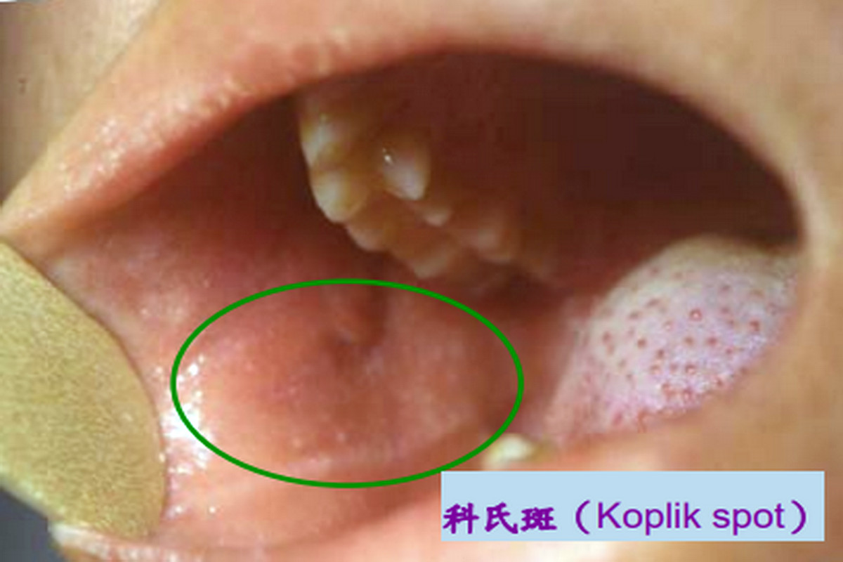 科氏斑。(資料來源:高雄長庚醫院黃高彬部長提供)<br /><br />