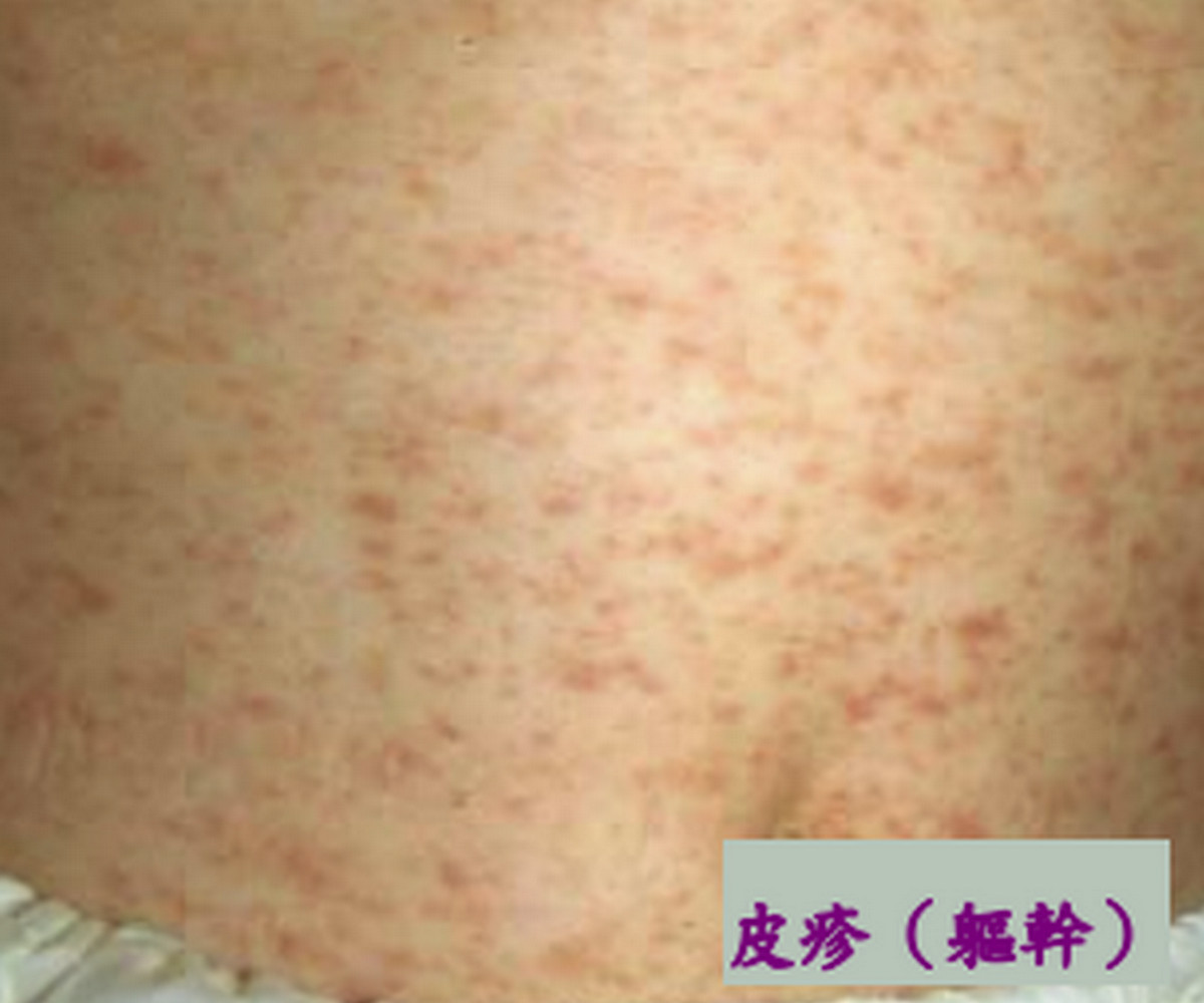 皮疹(軀幹)。(資料來源:高雄長庚醫院黃高彬部長提供)<br /><br />