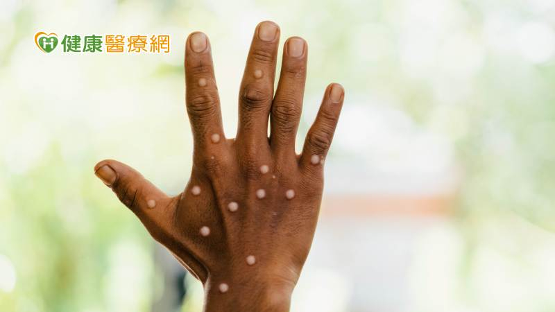 WHO決議M痘持續列為「公衛緊急事件」 並提供8項M痘臨時建議