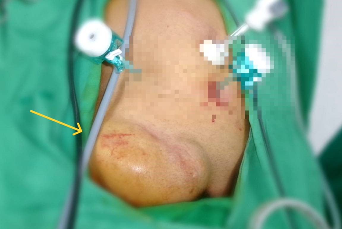 近八旬老翁下面「鼓一包」腹痛求醫 高醫岡山醫院精準腹腔鏡手術防堵保命