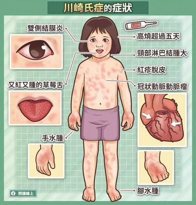 川崎氏症的症狀