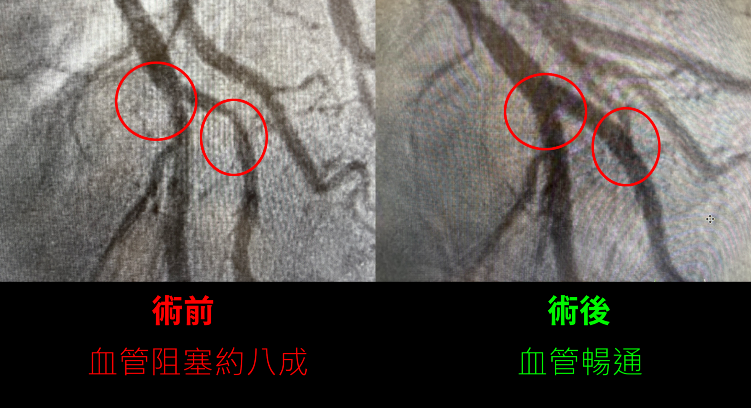 手術前患者呼吸困難、易喘無力,心律不整嚴重影響生活;手術後血流恢復順暢,體力明顯改善,重拾健康正常生活。(圖/記者林照東翻攝)