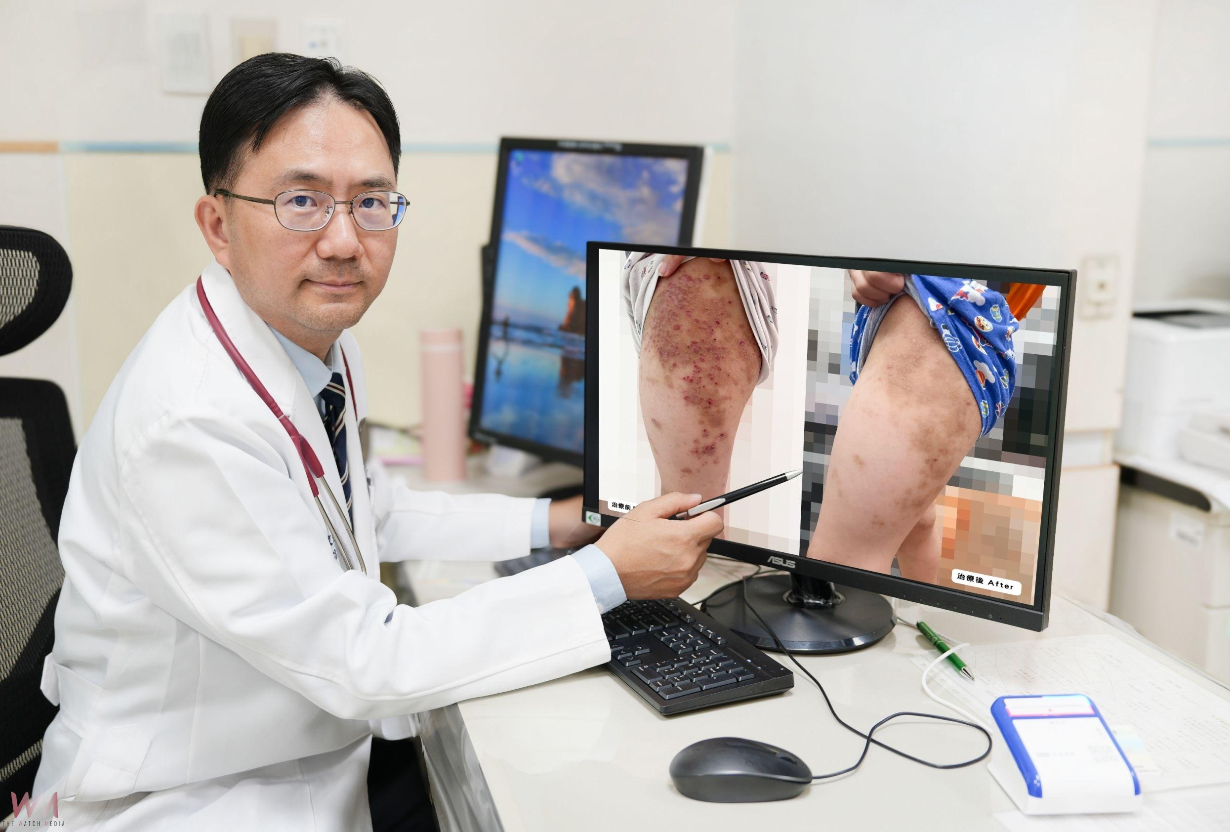異位性皮膚炎新療法　中醫大兒醫：生物製劑助孩童擺脫長期紅疹與搔癢