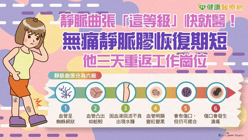 靜脈曲張「這等級」快就醫!無痛靜脈膠恢復期短 他三天重返工作崗位