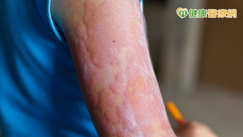 小一童異位性皮膚炎重度發作不敢上學! 「1精準治療」助自信重返校園