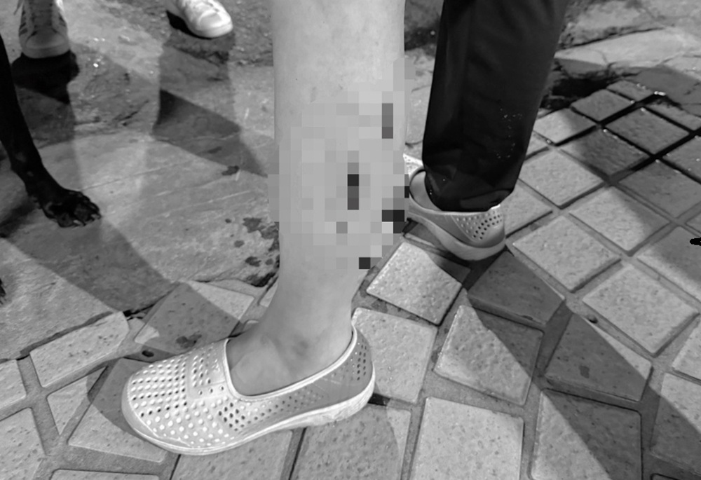 正妹牽狗散步遭惡犬攻擊 潔白小腿被咬3個洞 242 248250324a02
