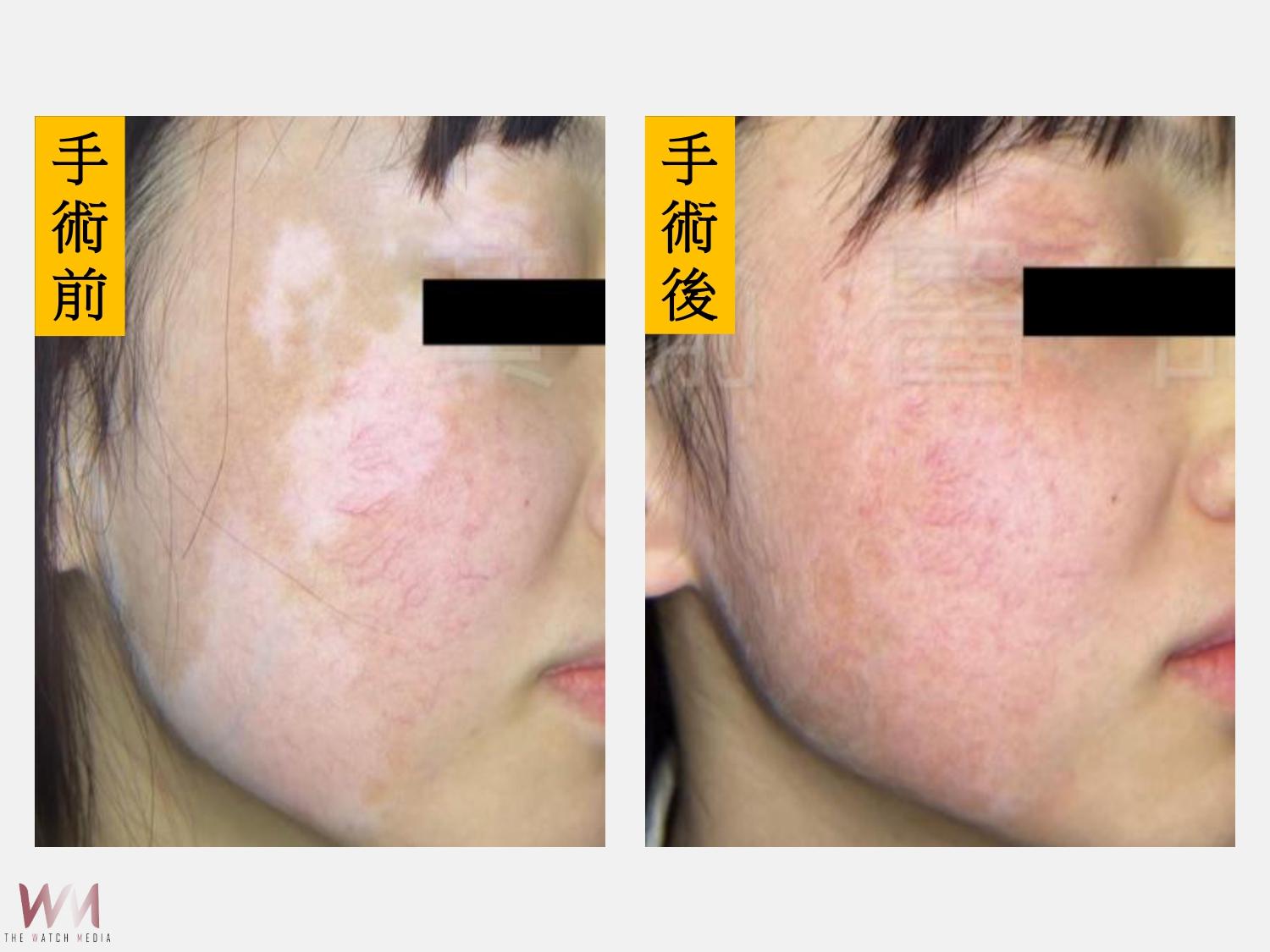 白斑色素移植手術　仁愛長庚 助12歲女童改善膚色 - https://www.watchmedia01.com