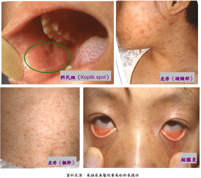 麻疹疫情升溫!清明連假慎防境外移入感染風險 55 3