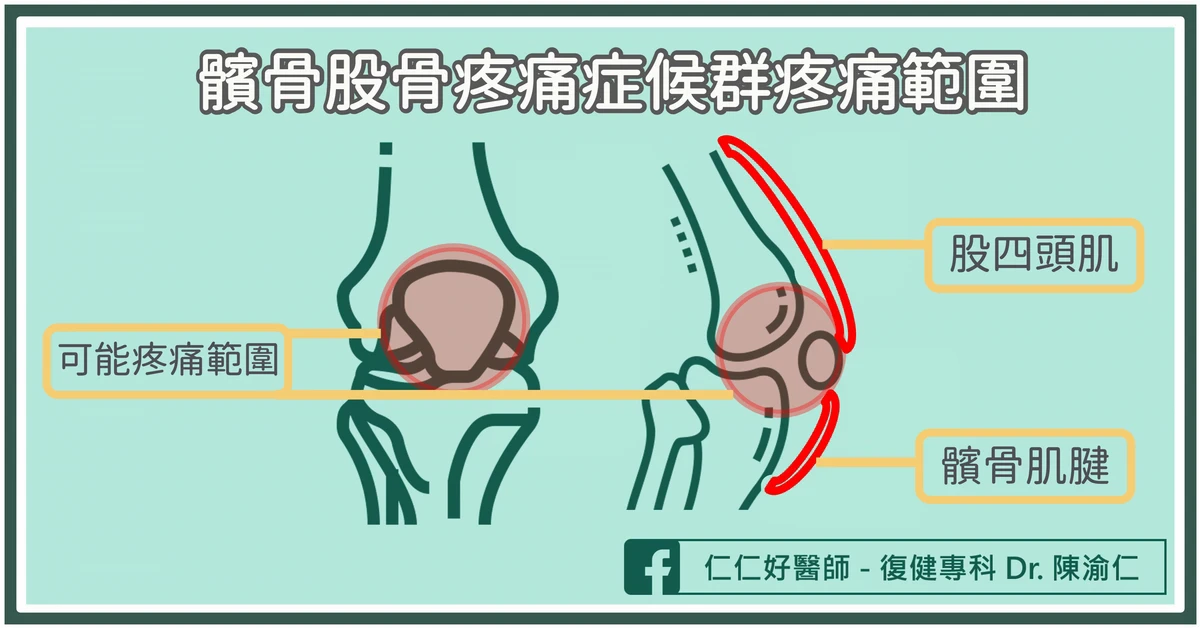 什麼是「髕骨股骨疼痛症候群」？